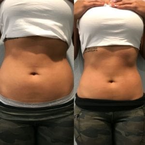 body-contouring-cryoskin-jacksonville