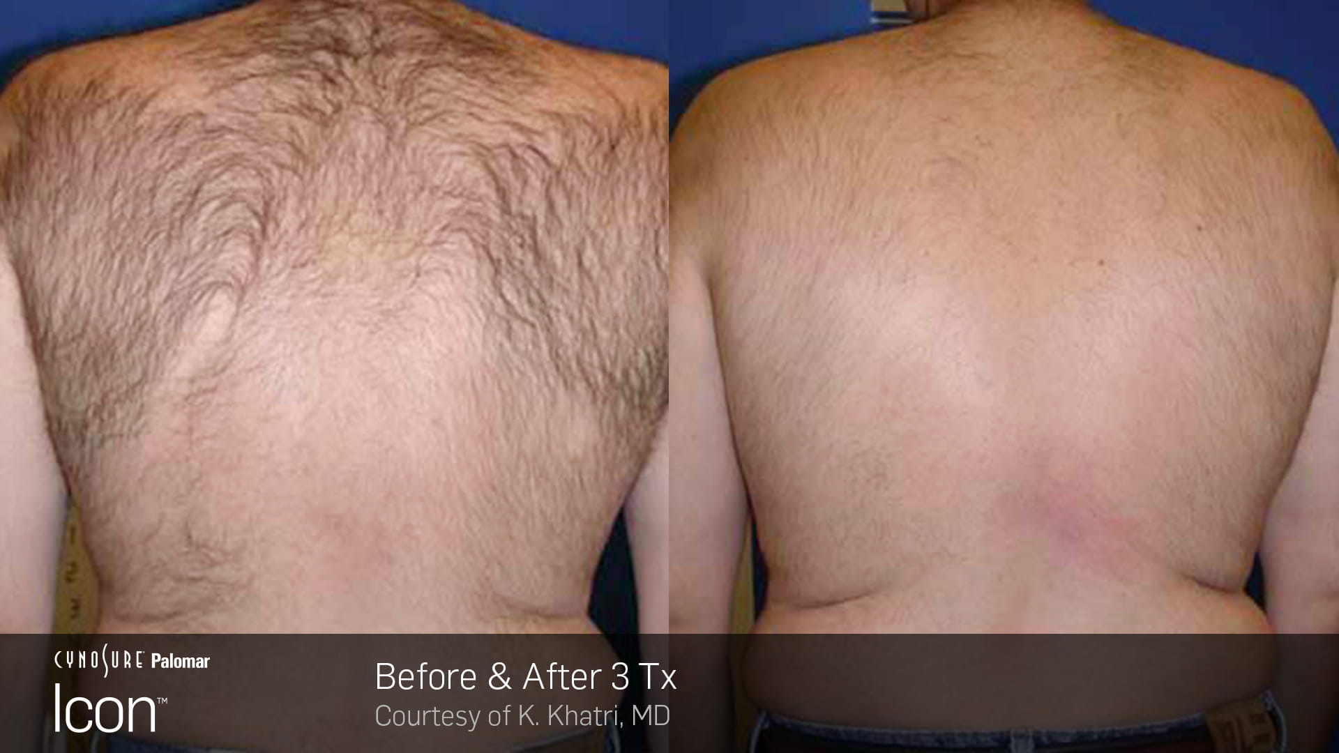 Hair Removal Before & After Photo 5