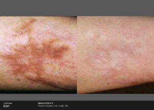 Scar Removal Before and After Images 4