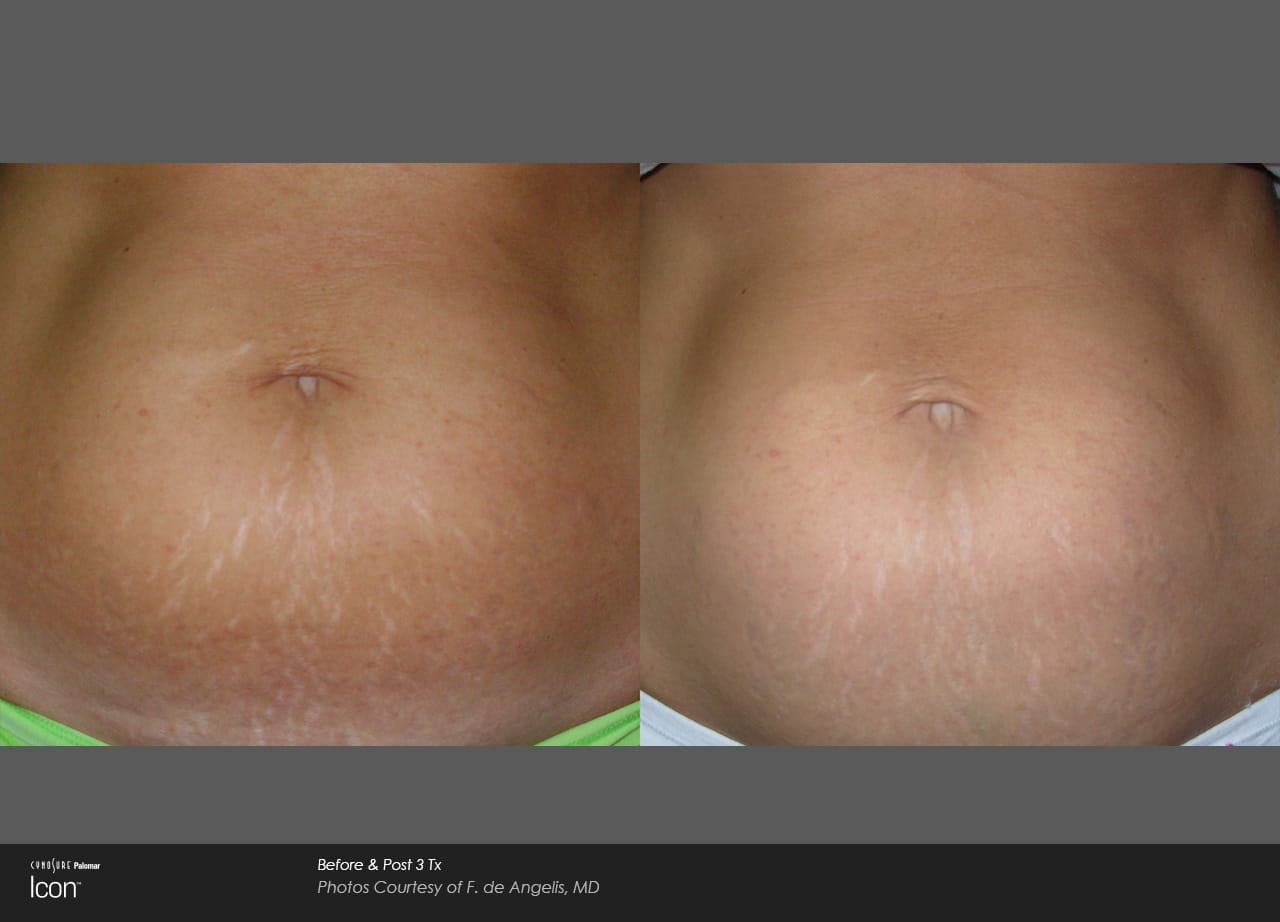 Stretch Mark Before And After image 3