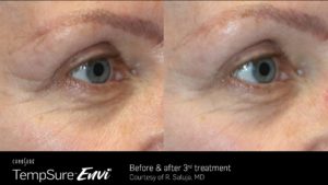 TempSure Envi Before and After Image 2