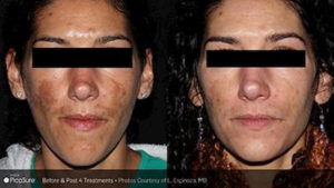 Melasma Treatment Before and After Image 2
