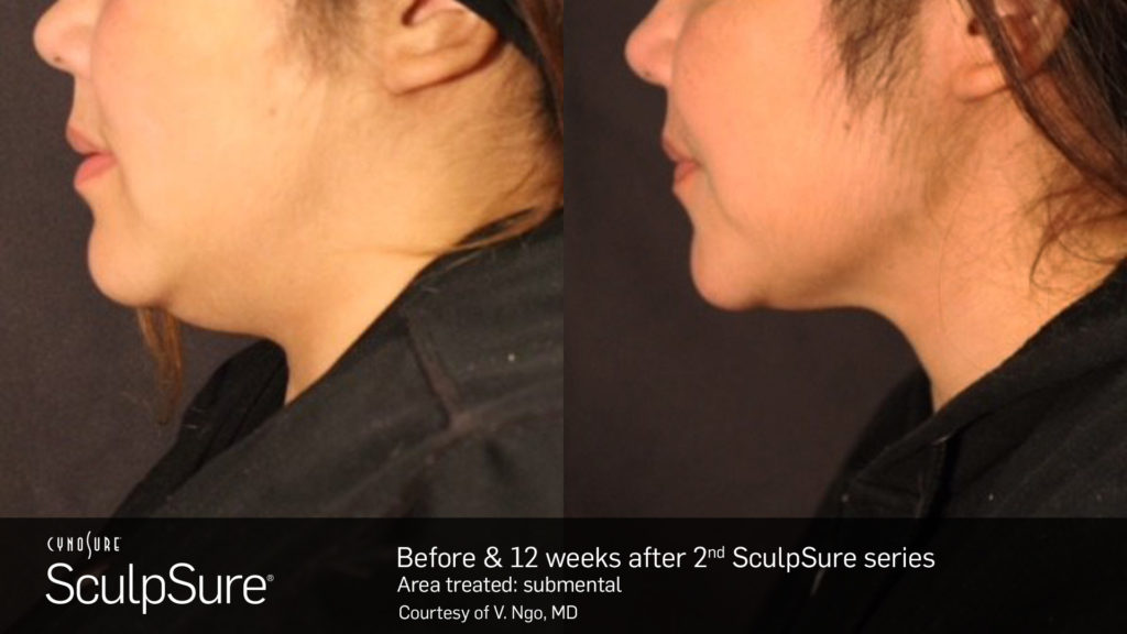 sculpsure-jacksonville-florida-1