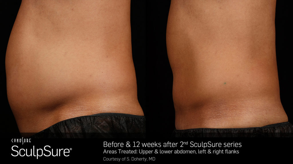 SculpSure-jacksonville-florida-joe