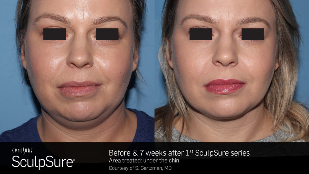 SculpSure-jacksonville-florida-may