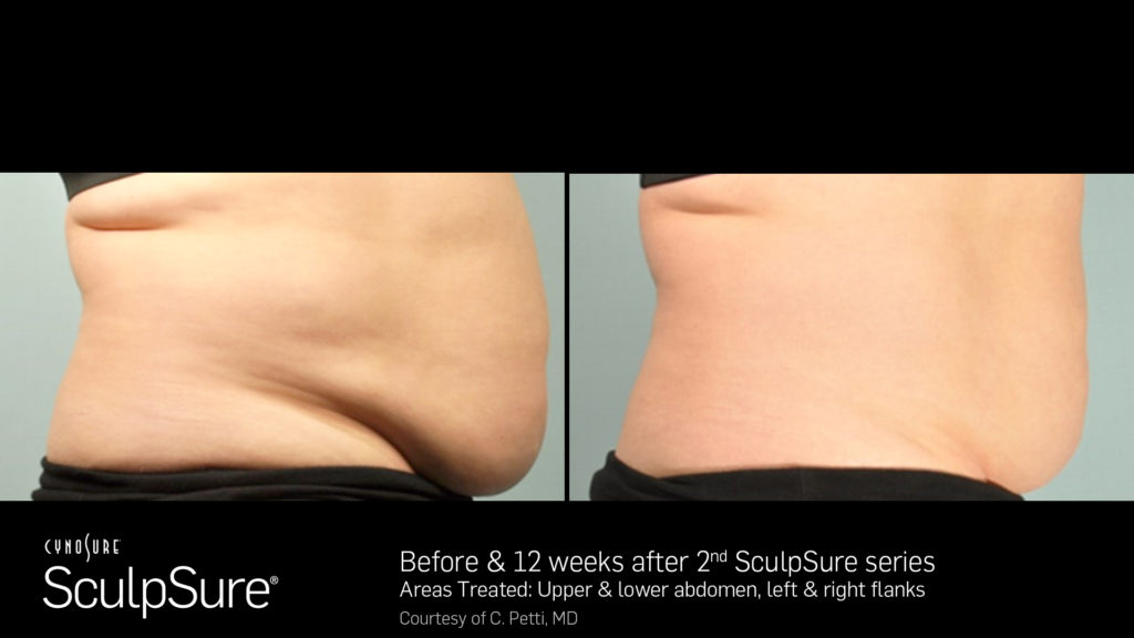 sculpsure-jacksonville-florida-thin-md-medspa